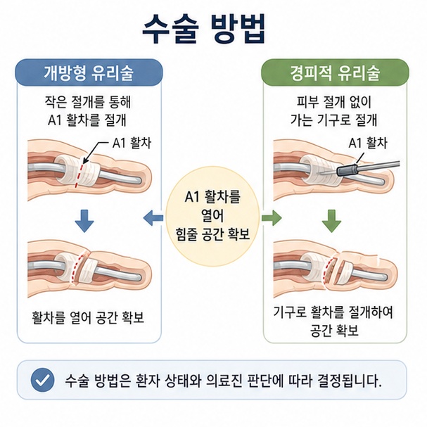 작은 절개를 이용하는 개방형 유리술과 기구를 이용하는 경피적 유리술로 A1 활차를 풀어 주는 방법을 비교한 이미지