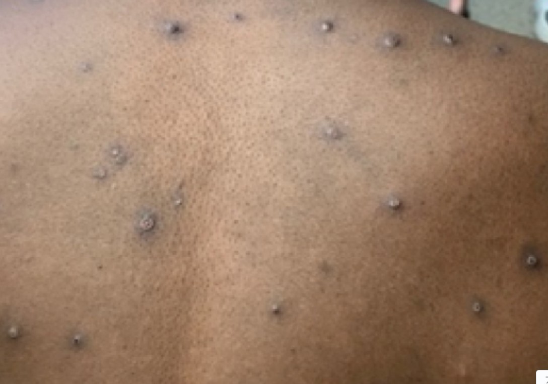 엠폭스 뜻 어떤 증상 및 원인 엠폭스 격리 및 예방접종