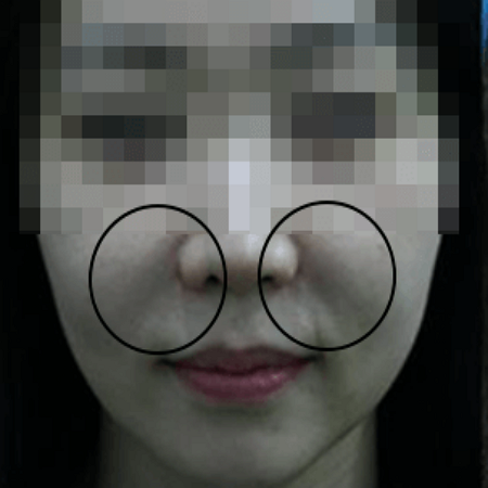 팔자주름 보톡스 맞기 전 사진