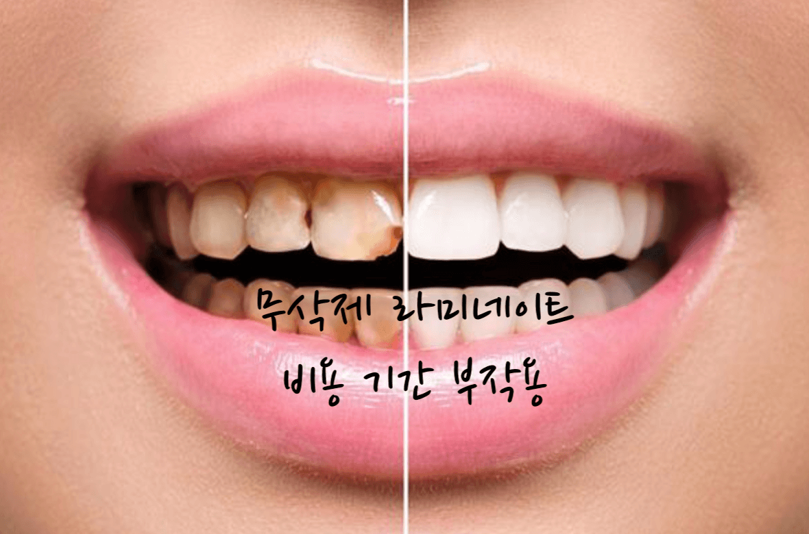 무삭제 라미네이트