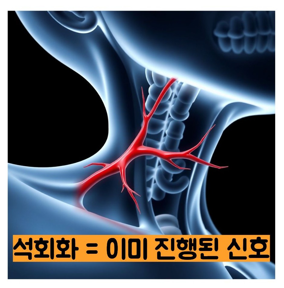 경동맥 석회화 경화반