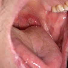 구내염 식이요법