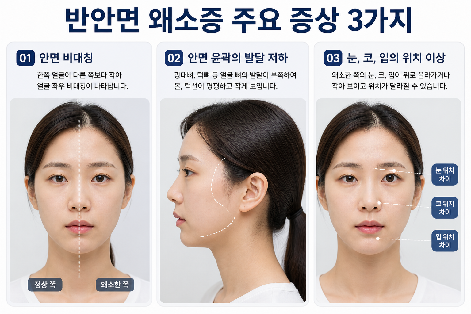 반안면 왜소증 증상.원인.치료