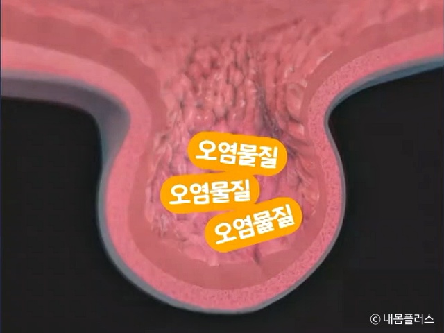 장에 독소가 쌓이면 나타나는 증상, 장독소배출방법 장독소자가진단, 장게실염 대장암, 건강 팁줌 매일꿀정보