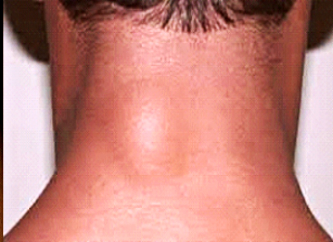 목뒤 지방종 사진