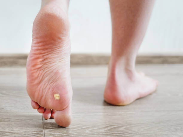 티눈 생기는 이유&amp;#44; 굳은살과 사마귀 차이 및 치료에 대해 알아봤습니다. 한번쯤은 손과 발에 티눈이 발생하는 것을 볼 수 있습니다. 티눈이 생기는 이유와 굳은살&amp;#44; 사마귀 차이점&amp;#44; 치료법&amp;#44; 티눈약 부작용 및 주의사항도 참고하시기 바랍니다. 