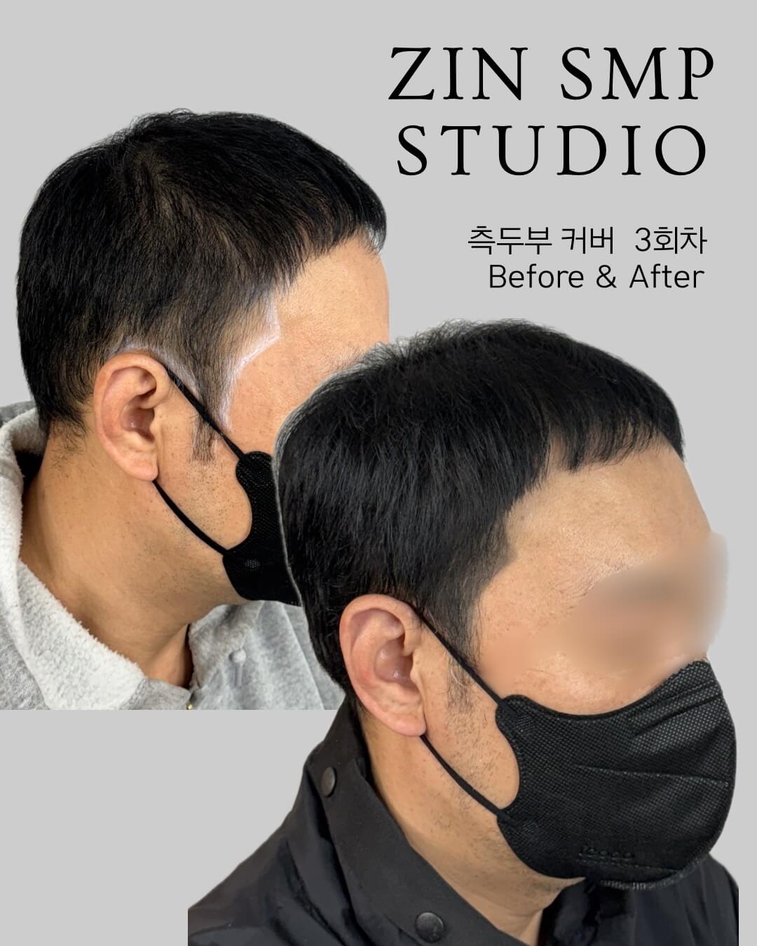 두피문신 잘하는곳