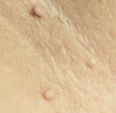 쥐젖 제거방법 22