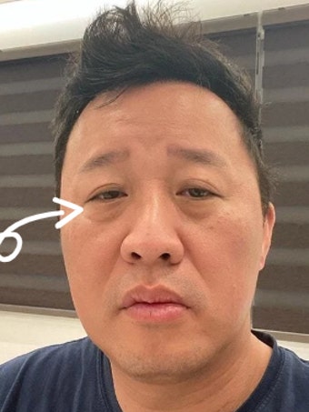 눈밑처짐