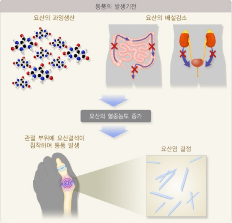 통풍 초기증상
