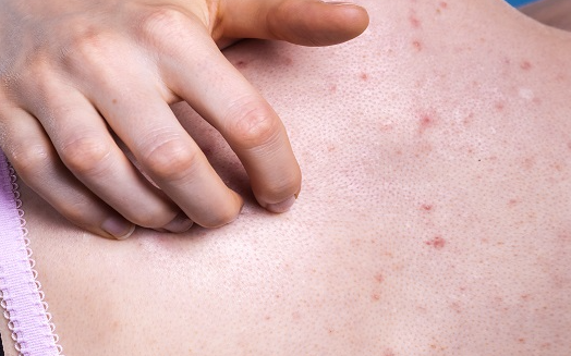 여름철, 등.가슴 여드름 왜 생길까요?