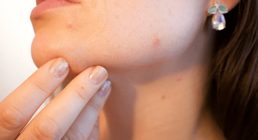 몸에 빨간 점이 생기는 이유로 얼굴에 점이 생긴 여인