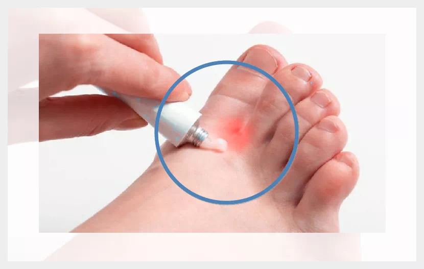 무좀 습진약 바르기