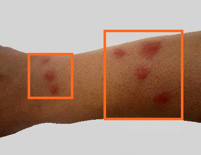 팔에 빈대 물린 자국