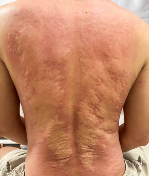 압박성 두드러기: 피부 압력으로 생기는 두드러기와 PMLE 비교 완전 가이드