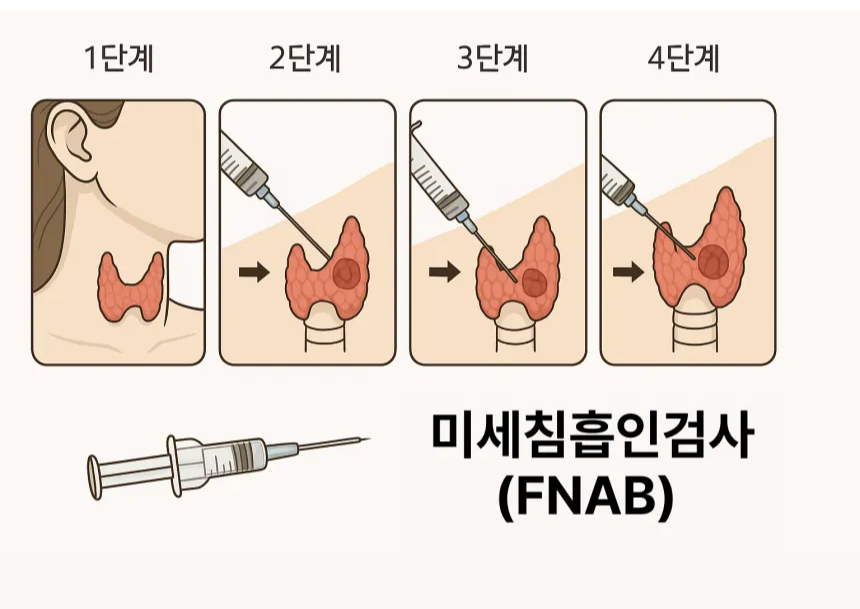 갑상선 조직검사