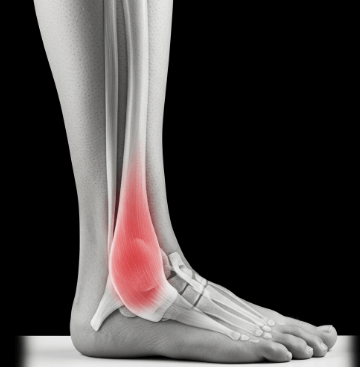 아킬레스건 염증 자가 치료법3