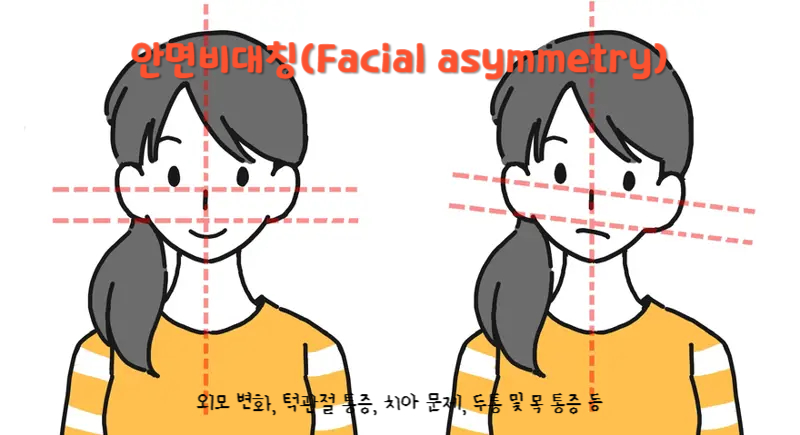 안면비대칭(Facial asymmetry)
안면비대칭 주요 증상 : 외모 변화, 턱관절 통증, 치아 문제, 두통 및 목 통증 등