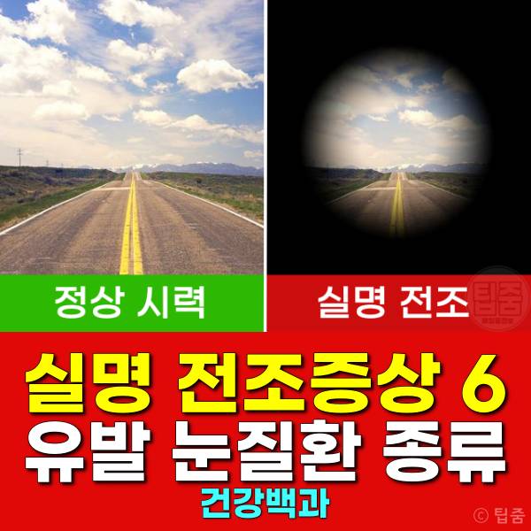 실명 전조증상 당뇨망막병증 황반변성 녹내장 백내장 고도근시 터널비전