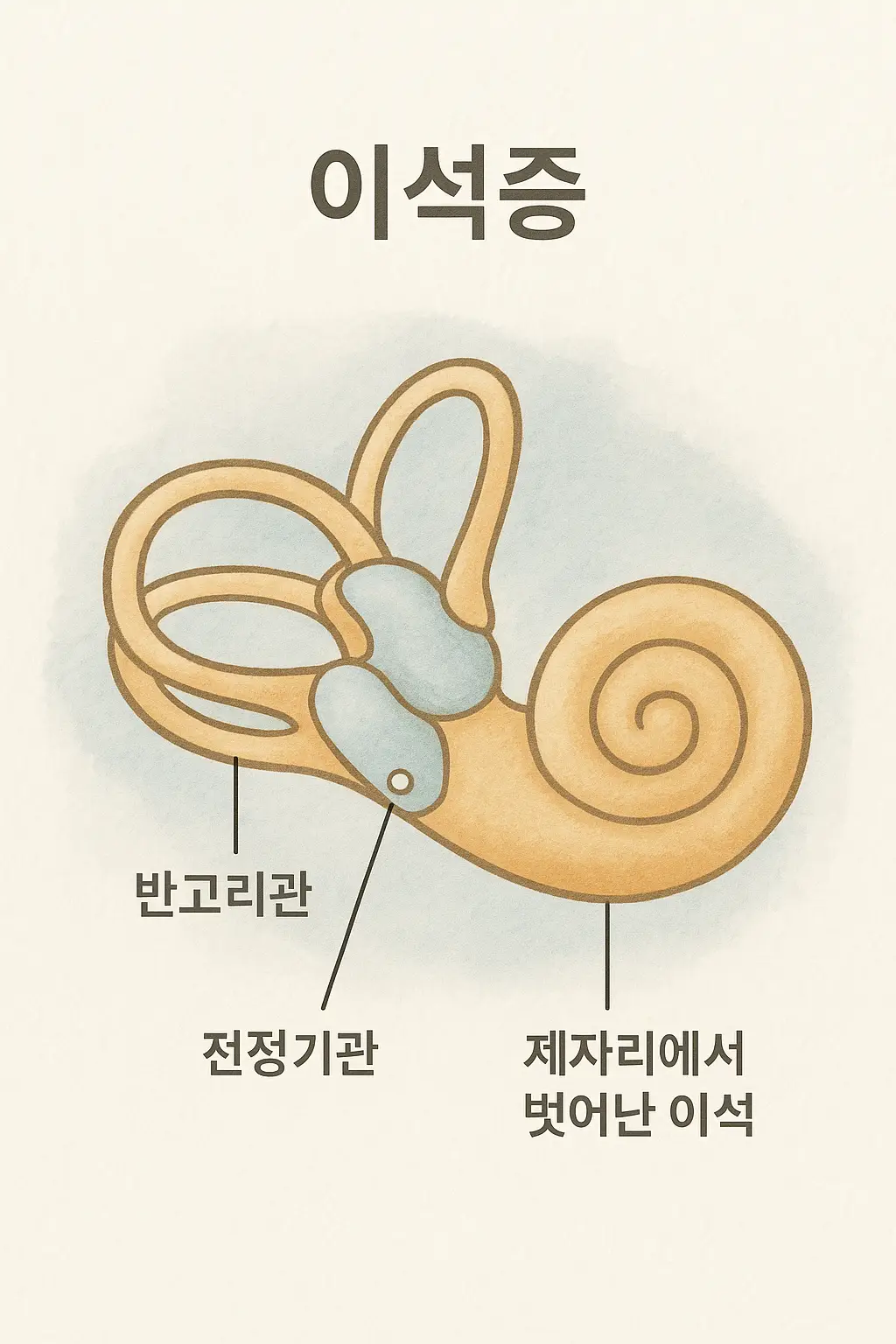 이석증 원인 설명을 위한 귀의 내이 구조 그림, 반고리관과 전정기관, 제자리에서 벗어난 이석