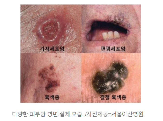 피부암 초기증상