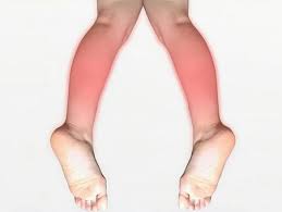 종아리 근육 통증 원인