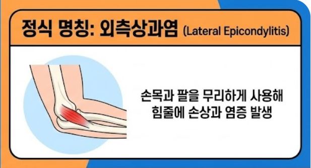 테니스 엘보 치료법