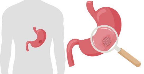 위암 초기증상, 수술비용, 수술후 회복기간 총정리 (2024ver)