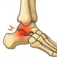 발목 접질렀을때