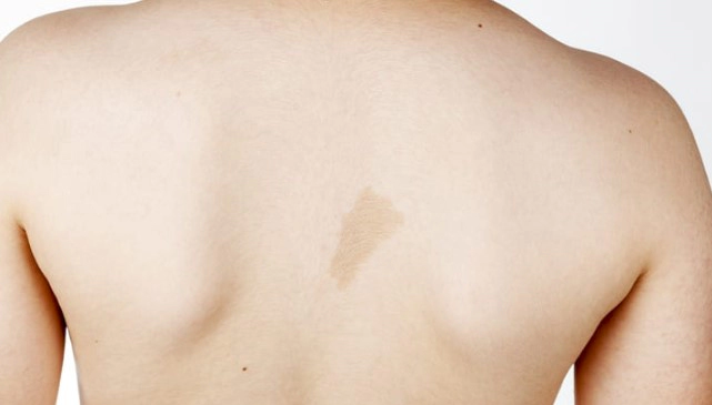 신경섬유종 밀크반점 증상 7가지