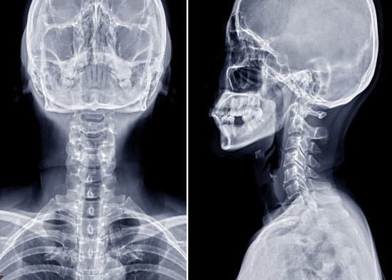 경추 디스크 X-ray (방사선 검사): 목적과 절차