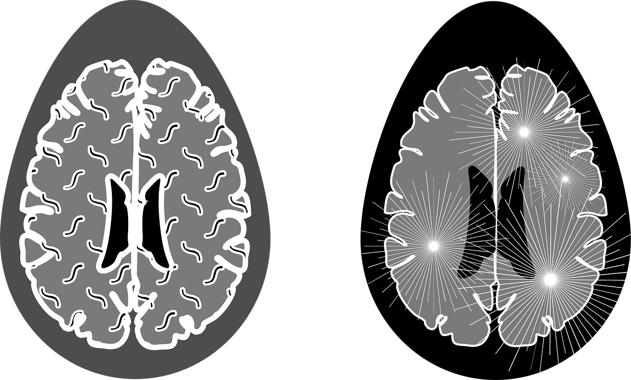 치매 초기 검사 필수 이유