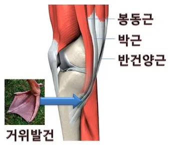거위발 건염 원인과 증상 무릎 안쪽 통증 치료법 정리_2