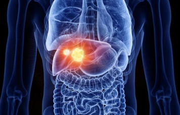 간암(Liver Cancer)