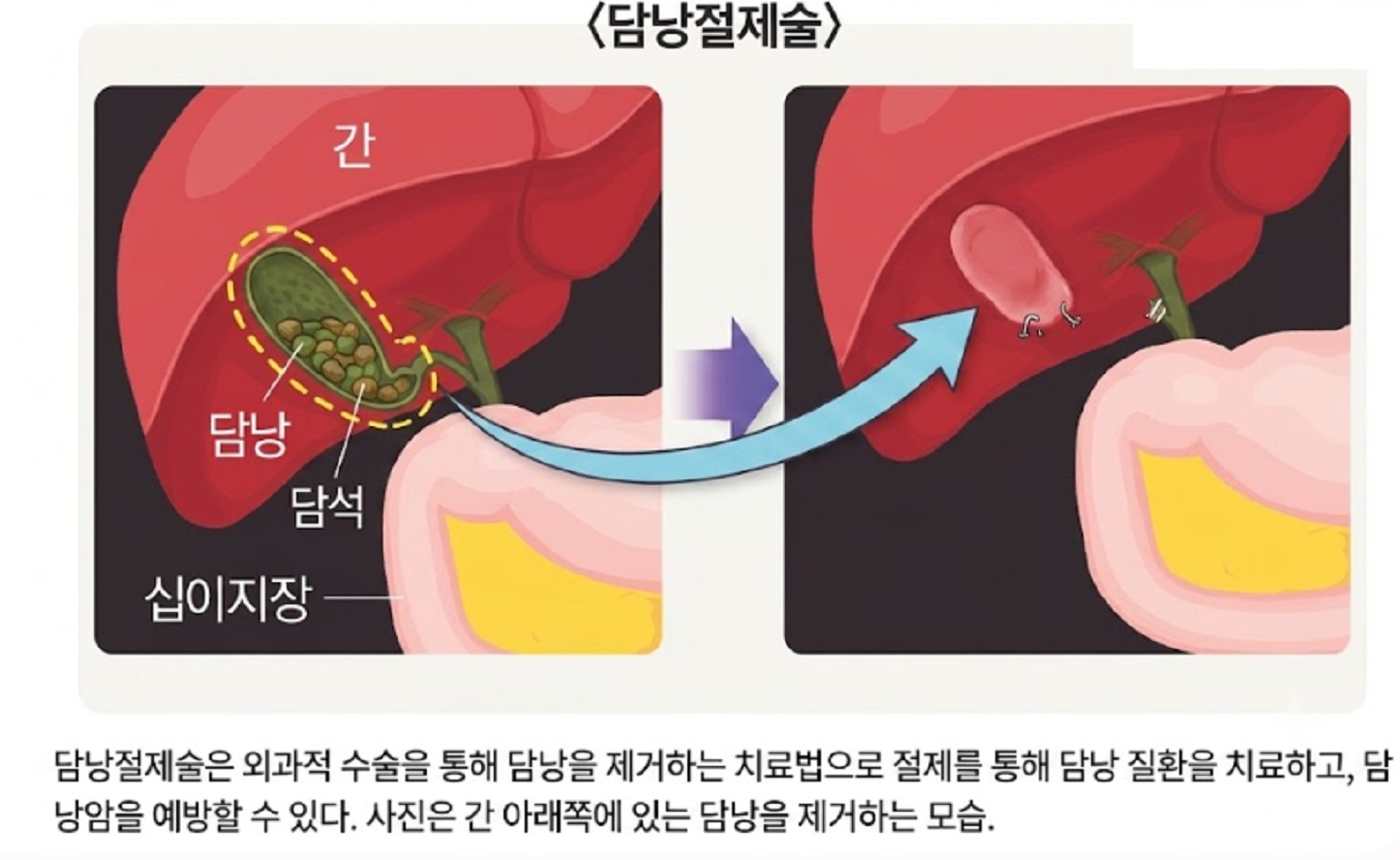 담낭절제술