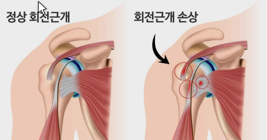 어깨통증 3