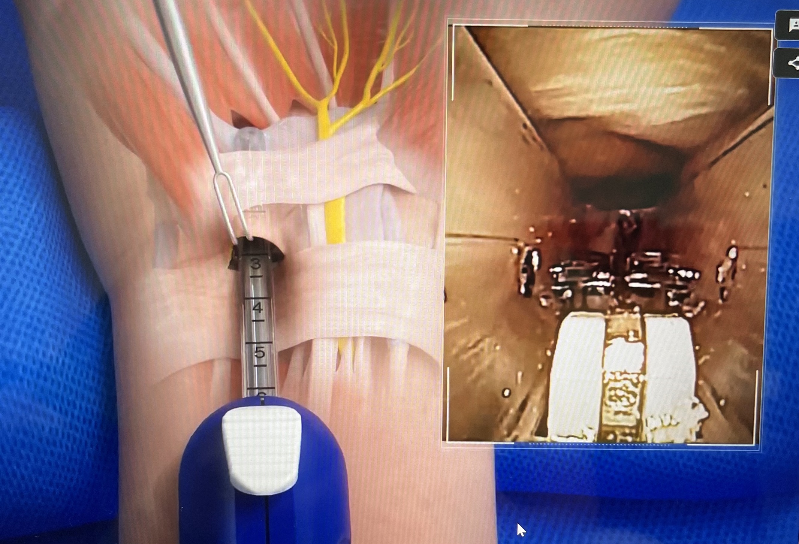 수근관 증후군 수술