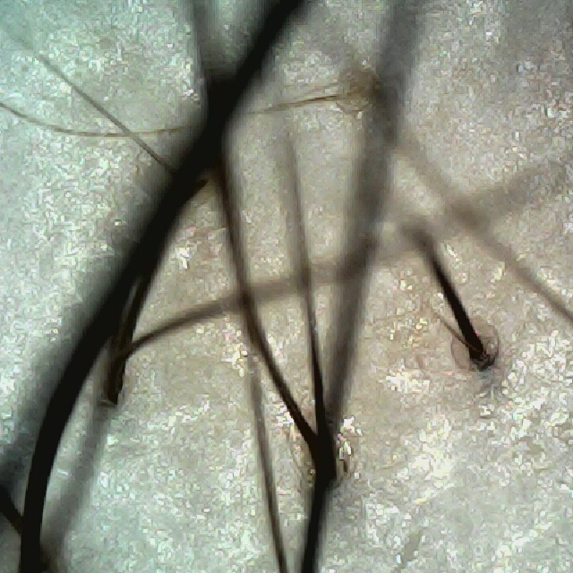 정수리와 이마사이 두피 모습이다.