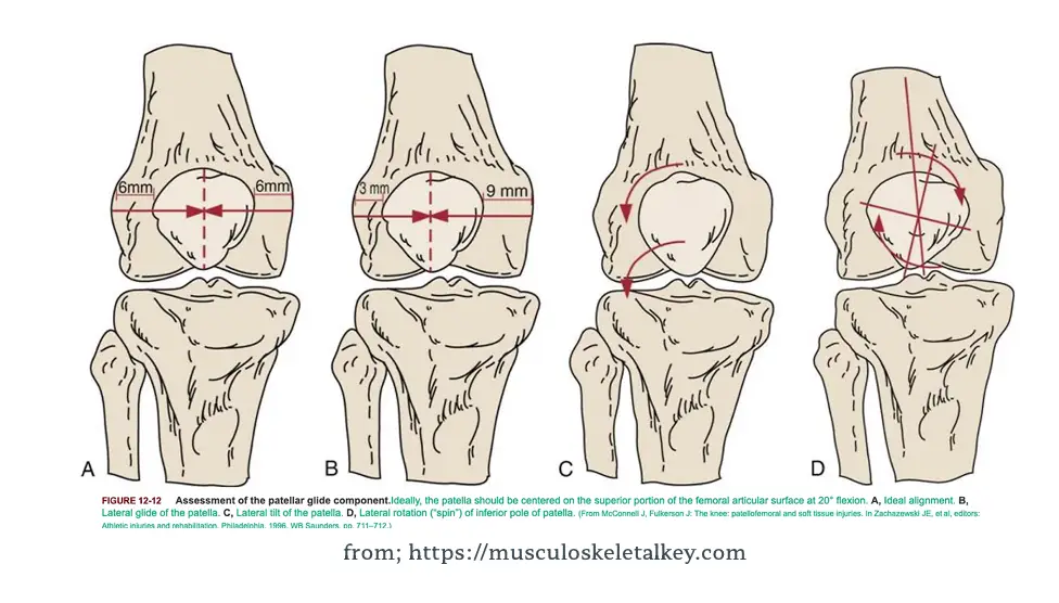 슬개대퇴통증증후군: 원인, 증상 및 효과적인 관리 방법