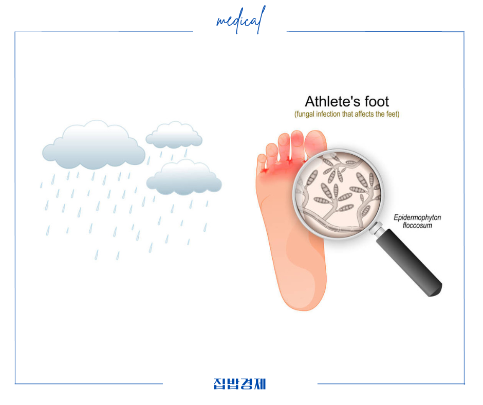 장마철 무좀