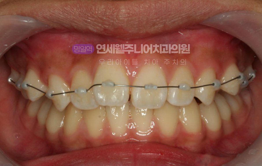 중학생 MTA 미니튜브 교정장치와 와이어를 부착한 상악 치아 정면 사진