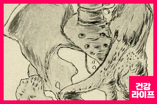 고관절 통증 원인 10가지