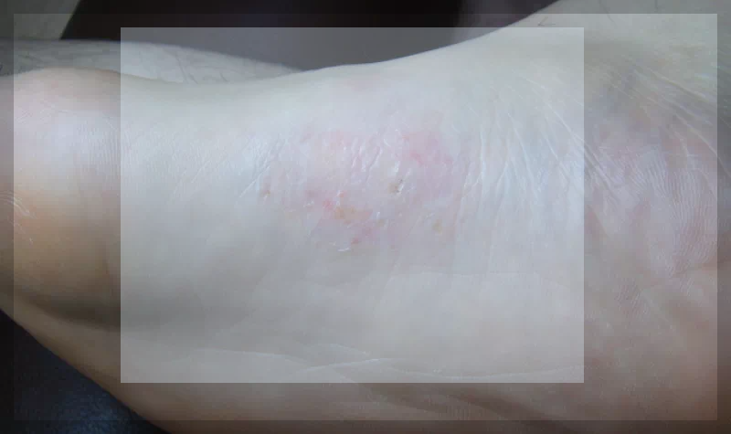 발바닥 옆부분 수포형 무좀