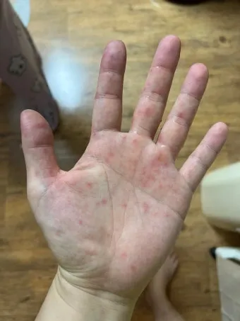 수족구 초기 증상 어른 감염 격리기간 예방 치료 완전 가이드_17