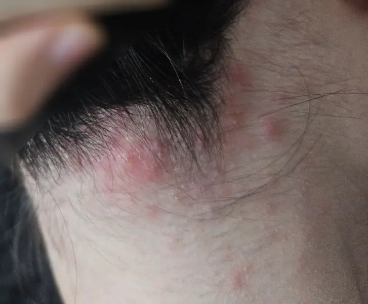 에스테틱 마사지 받은 후 생긴 목 뒤 여드름