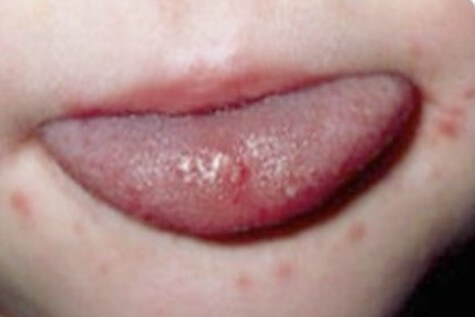 수족구 증상이 입에 나타남
