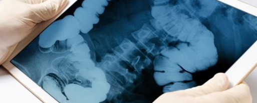 대장암 초기증상2