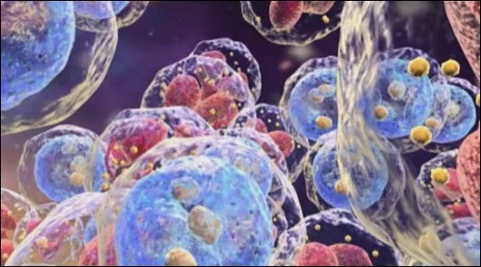 방광암 초기증상 -5