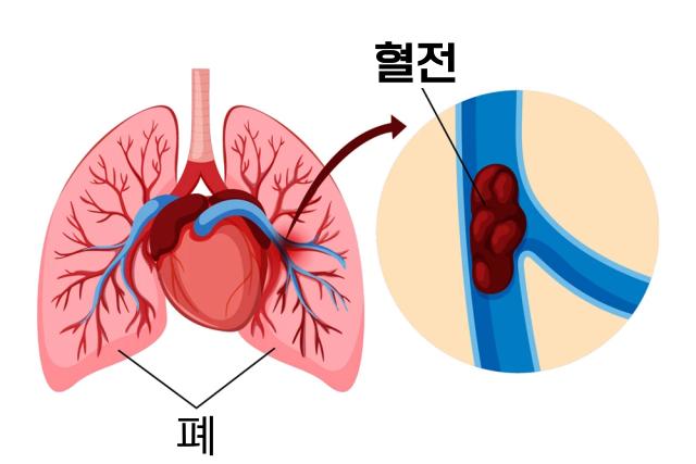 숨쉴때 가슴통증 폐색전증 전조증상