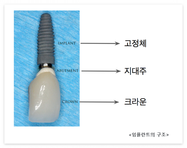 임플란트 가격